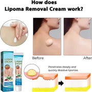 Lipoma Removal Cream